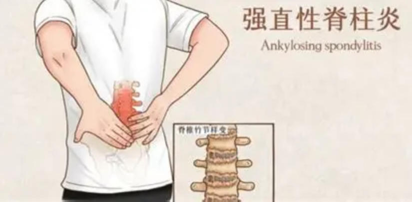 中医调强直：“一把抓百穴” 传人解锁世界性疑难痹症的千年传统调理智慧